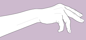 Figure 2. The effect of tendon rupture in the hand (ring finger and little finger extensor tendons are affected)